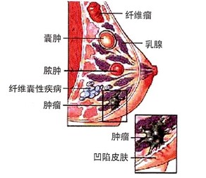 主页 乳腺疾病 乳腺囊肿       乳房肿瘤是是乳腺癌前期最常见的病症